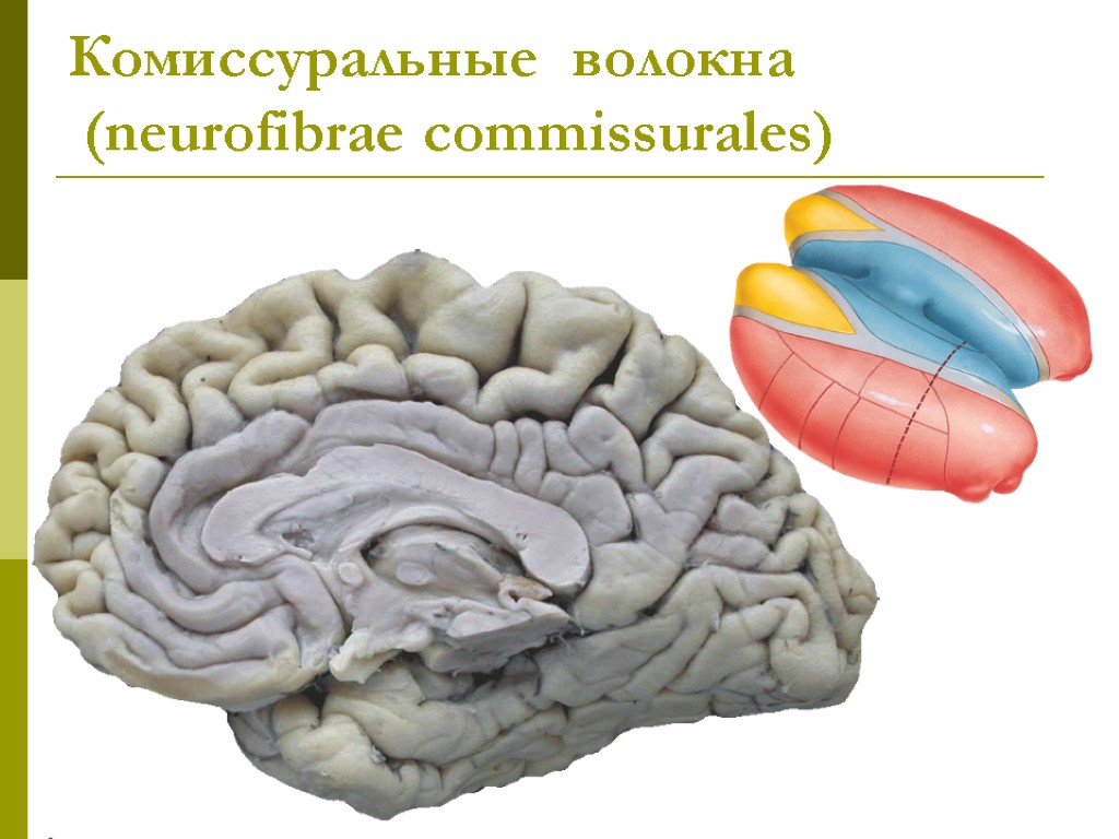 Комиссуральные волокна (neurofibrae commissurales)